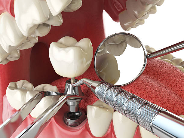 Best Emergency Root Canal Treatment in Laporte, CO